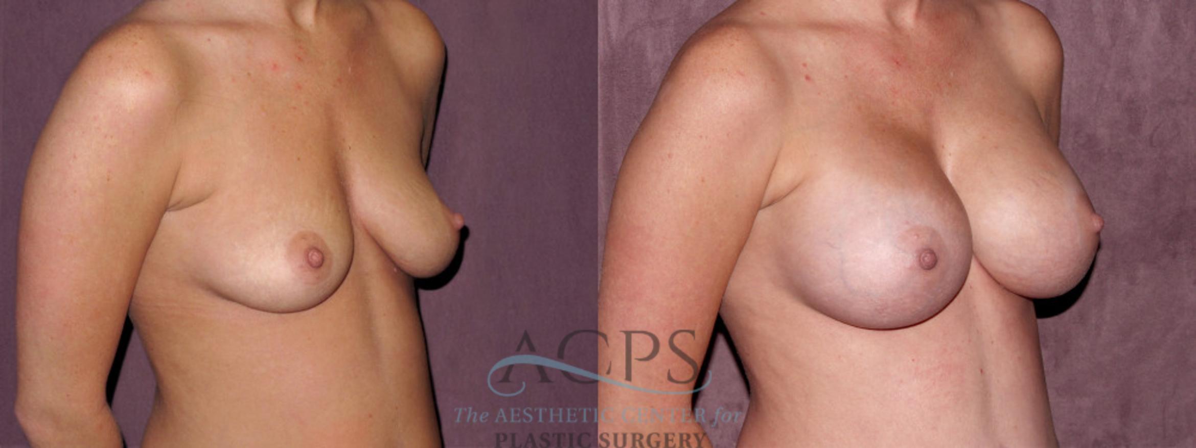 Before & After Breast Augmentation Case 972 Oblique Right View: View in Houston, TX