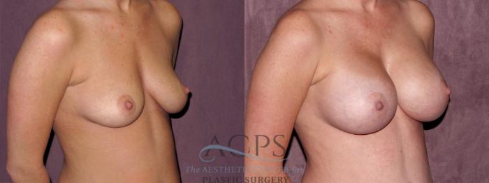 Before & After Breast Augmentation Case 972 Oblique Right View: View in Houston, TX