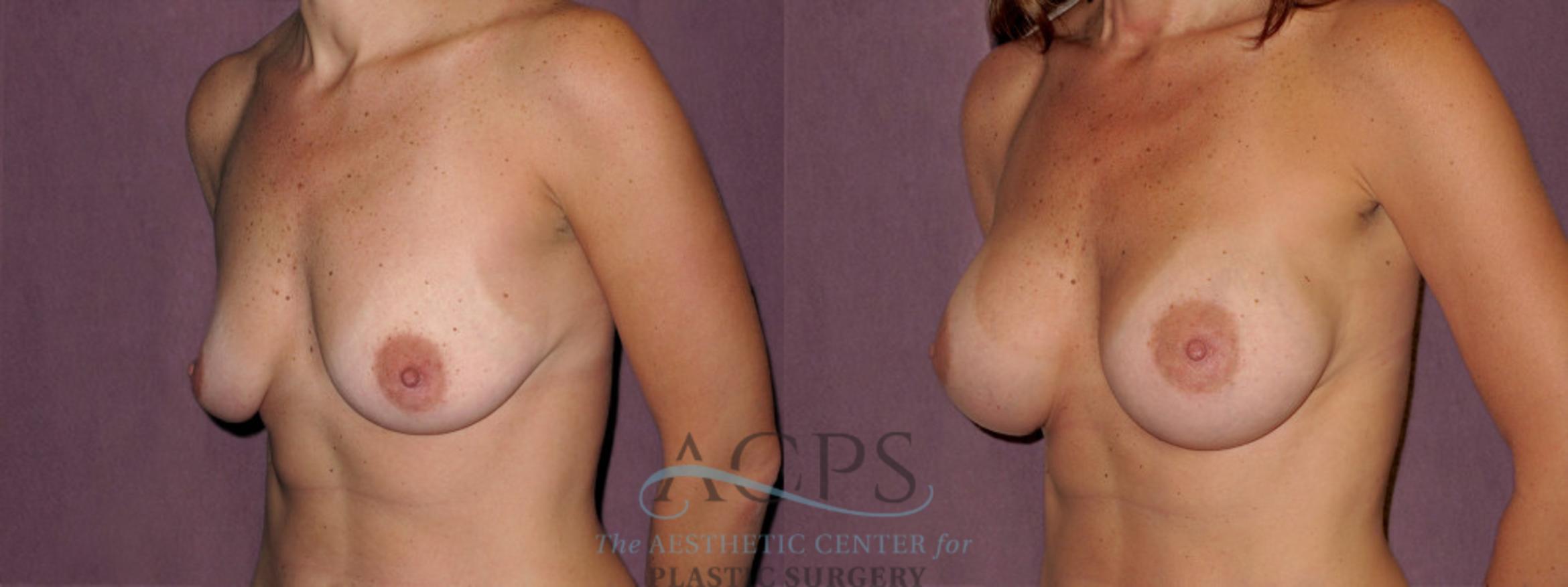 Before & After Breast Augmentation Case 973 Oblique Left View: View in Houston, TX