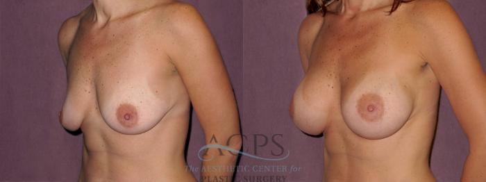 Before & After Breast Augmentation Case 973 Oblique Left View: View in Houston, TX