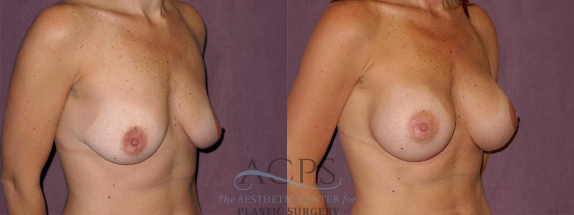 Before & After Breast Augmentation Case 973 Oblique Right View: View in Houston, TX
