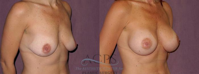 Before & After Breast Augmentation Case 973 Oblique Right View: View in Houston, TX