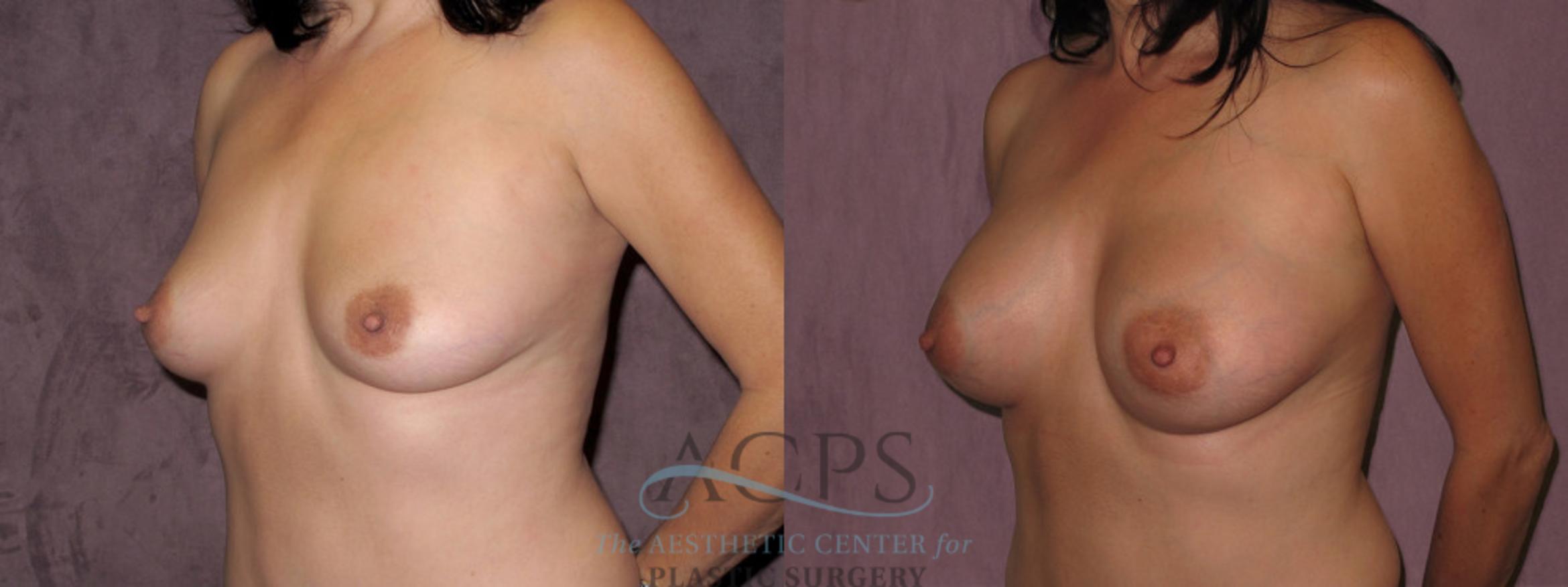 Before & After Breast Augmentation Case 974 Oblique Left View: View in Houston, TX