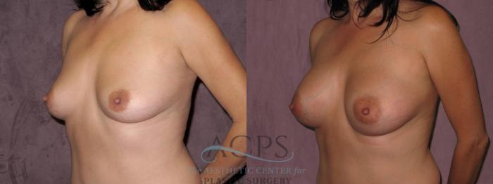 Before & After Breast Augmentation Case 974 Oblique Left View: View in Houston, TX