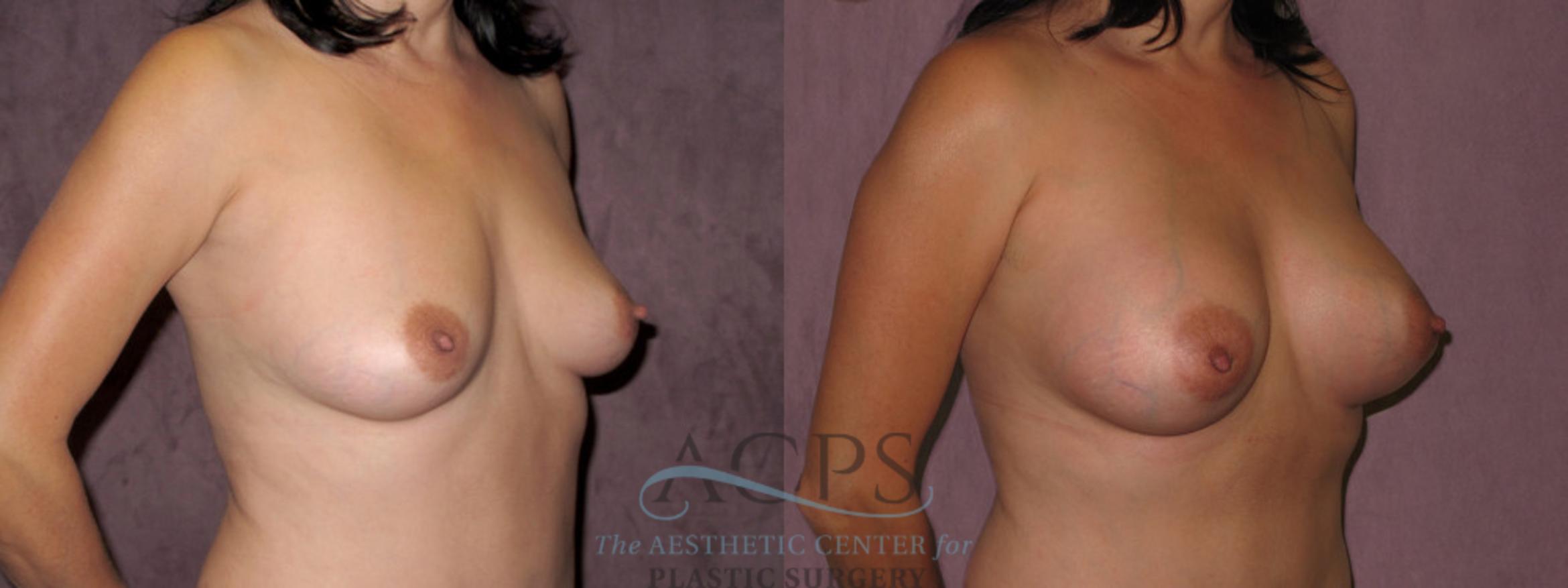 Before & After Breast Augmentation Case 974 Oblique Right View: View in Houston, TX