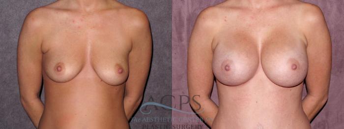 Before & After Breast Augmentation Case 975 Front View: View in Houston, TX