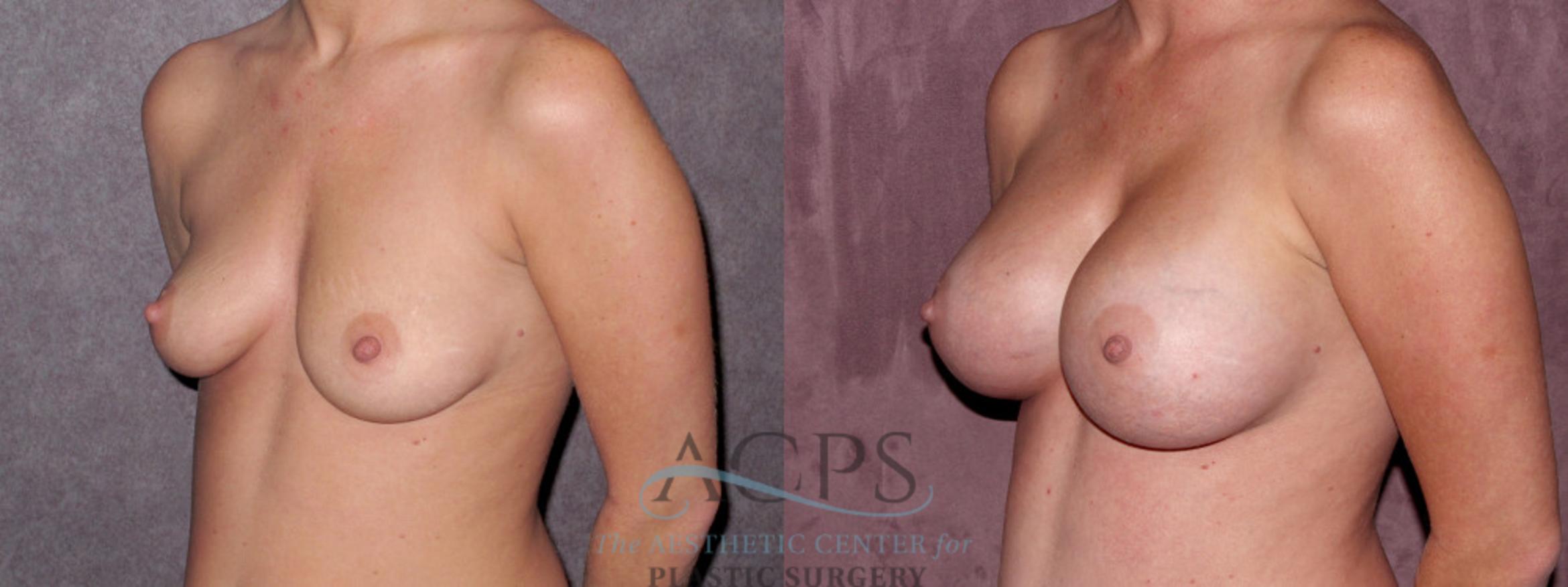 Before & After Breast Augmentation Case 975 Oblique Left View: View in Houston, TX