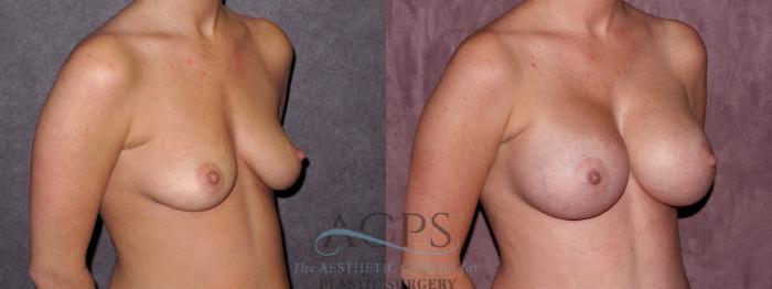 Before & After Breast Augmentation Case 975 Oblique Right View: View in Houston, TX