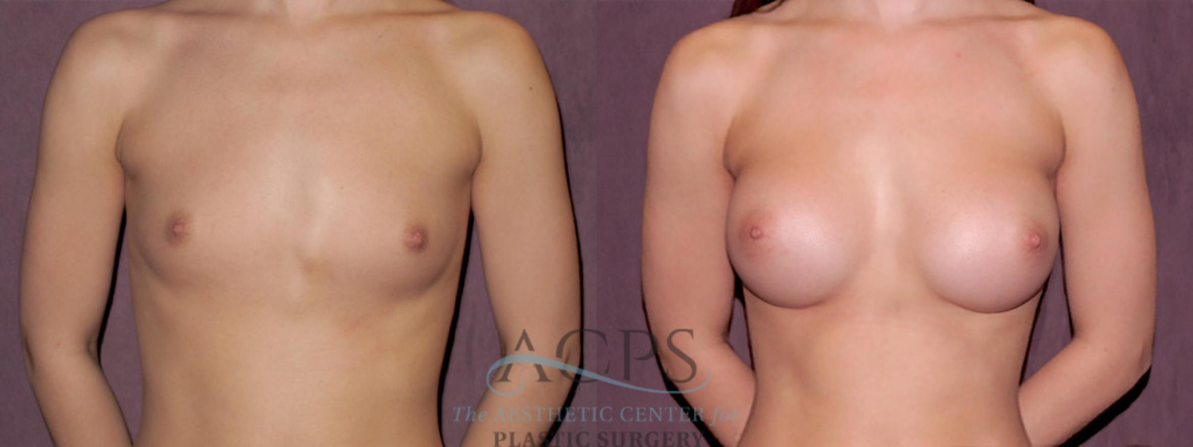 Before & After Breast Augmentation Case 977 Front View: View in Houston, TX