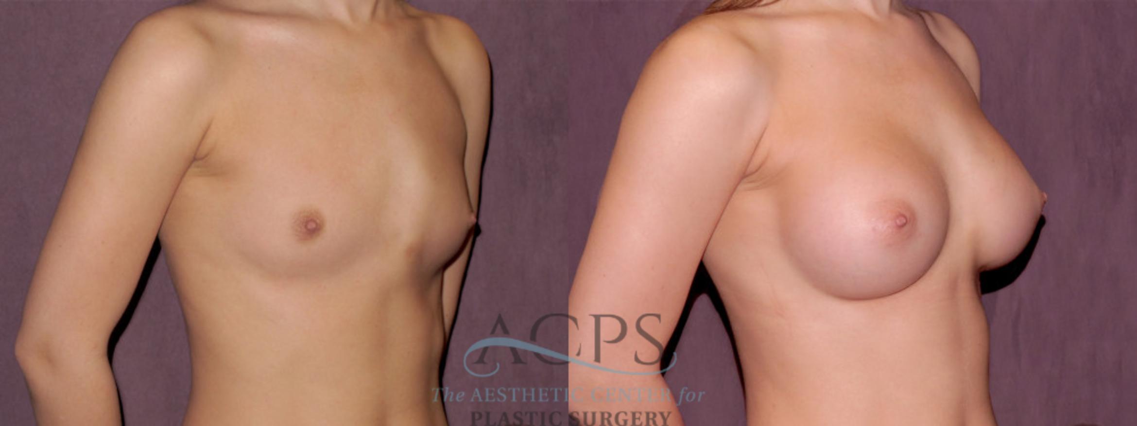 Before & After Breast Augmentation Case 977 Oblique Right View: View in Houston, TX