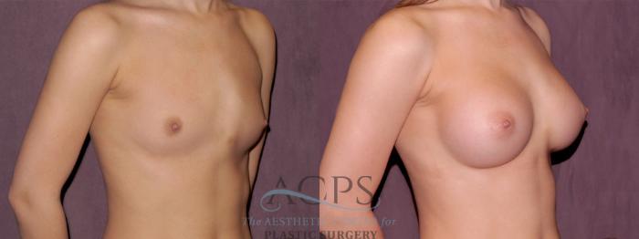 Before & After Breast Augmentation Case 977 Oblique Right View: View in Houston, TX