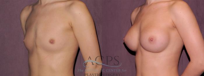 Before & After Breast Augmentation Case 977 Side Left View: View in Houston, TX
