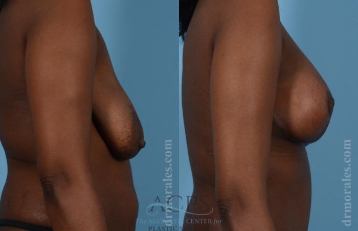 Before & After Breast Augmentation and Lift Case 1030 Side View: View in Houston, TX