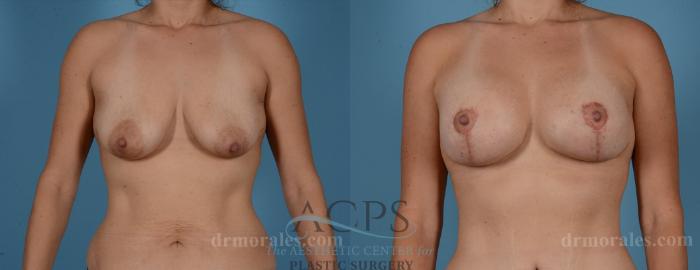 Before & After Breast Augmentation and Lift Case 1031 Front View: View in Houston, TX