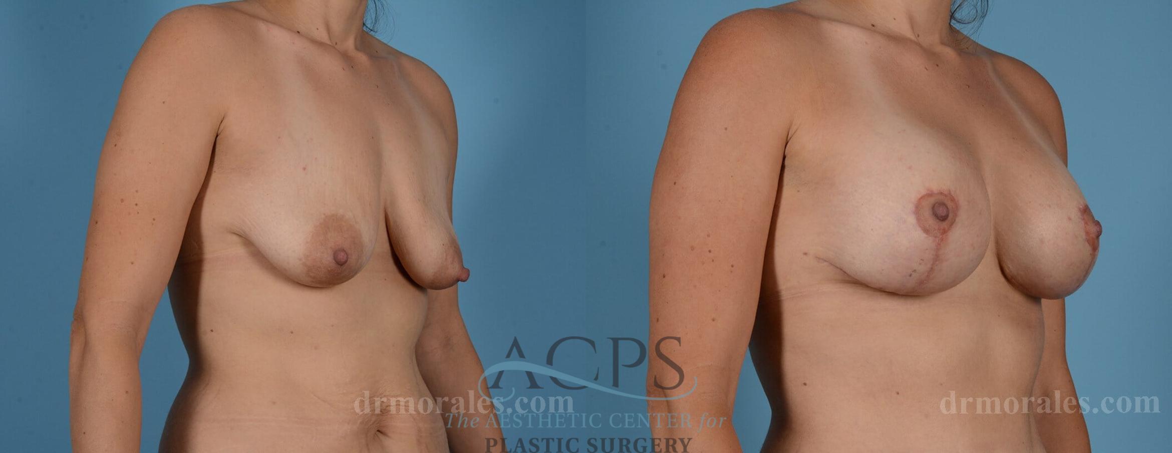 Before & After Breast Augmentation and Lift Case 1031 Oblique View: View in Houston, TX