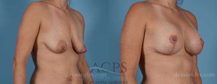 Before & After Breast Augmentation and Lift Case 1031 Oblique View: View in Houston, TX