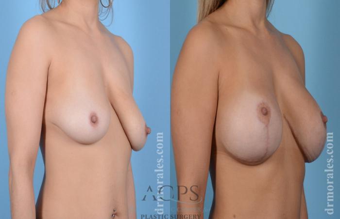 Before & After Breast Augmentation and Lift Case 1032 Oblique View: View in Houston, TX