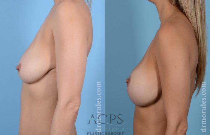 Before & After Breast Augmentation and Lift Case 1032 Side View: View in Houston, TX