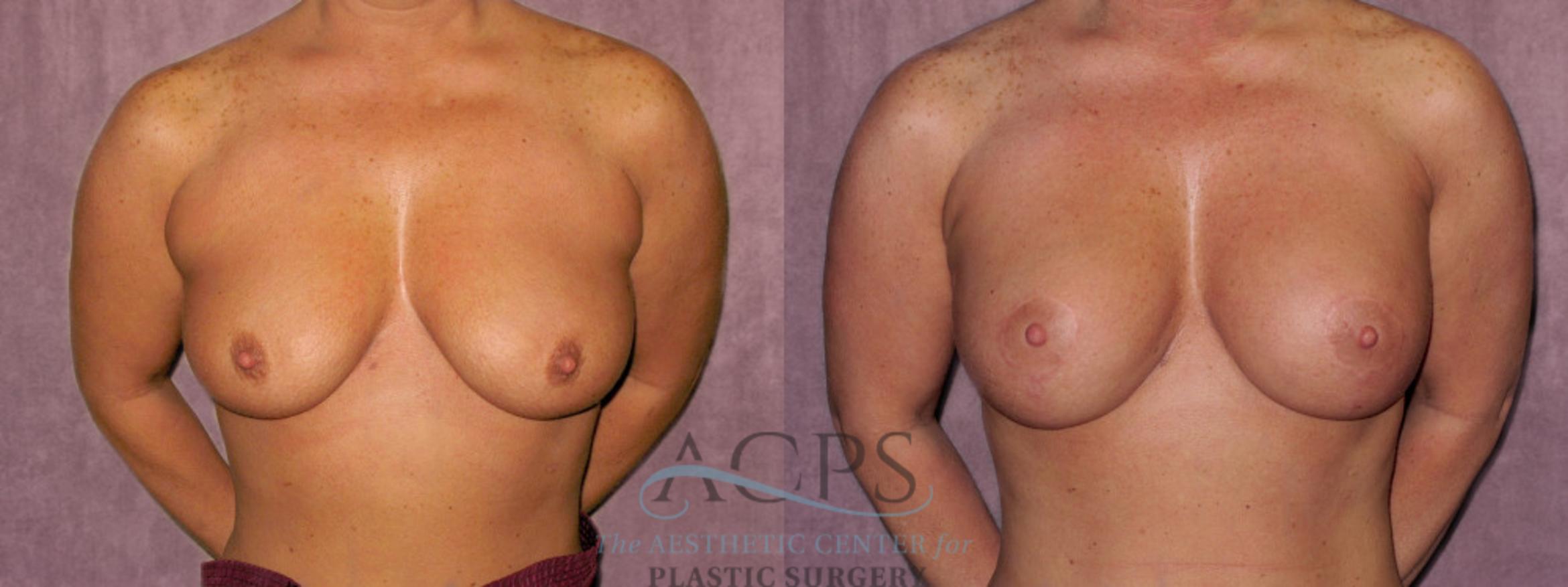 Before & After Breast Augmentation and Lift Case 1033 Front View: View in Houston, TX