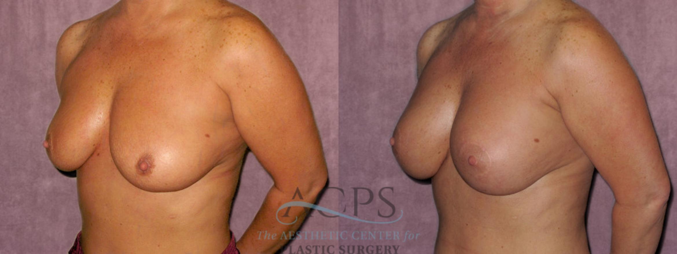 Before & After Breast Augmentation and Lift Case 1033 Oblique Left View: View in Houston, TX