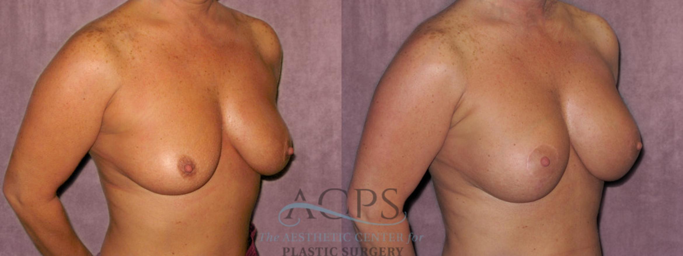 Before & After Breast Augmentation and Lift Case 1033 Oblique Right View: View in Houston, TX