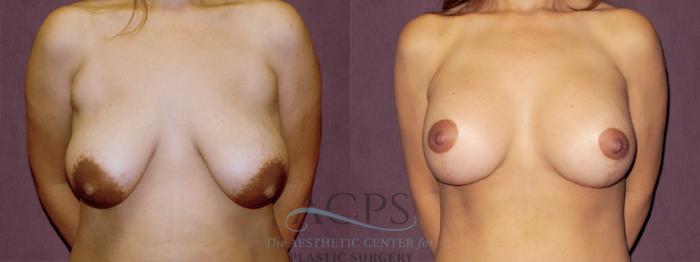 Before & After Breast Augmentation and Lift Case 1034 Front View: View in Houston, TX