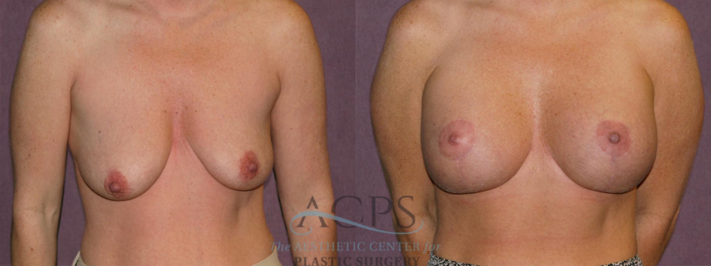 Before & After Breast Augmentation and Lift Case 1035 Front View: View in Houston, TX