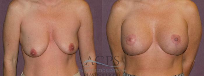 Before & After Breast Augmentation and Lift Case 1035 Front View: View in Houston, TX