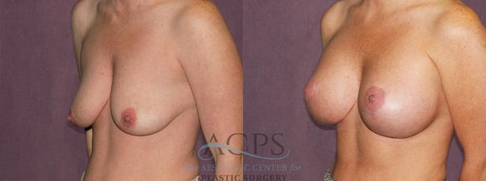 Before & After Breast Augmentation and Lift Case 1035 Oblique Left View: View in Houston, TX