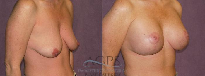Before & After Breast Augmentation and Lift Case 1035 Oblique Right View: View in Houston, TX