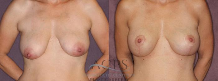 Before & After Breast Augmentation and Lift Case 1036 Front View: View in Houston, TX
