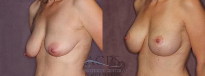 Before & After Breast Augmentation and Lift Case 1036 Oblique Left View: View in Houston, TX