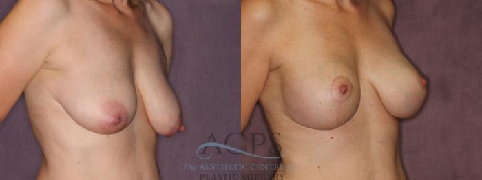 Before & After Breast Augmentation and Lift Case 1036 Oblique Right View: View in Houston, TX