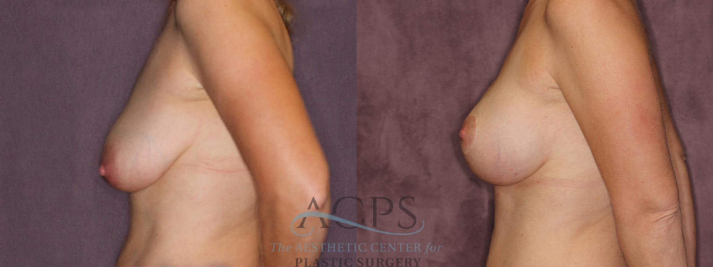 Before & After Breast Augmentation and Lift Case 1036 Side Left View: View in Houston, TX