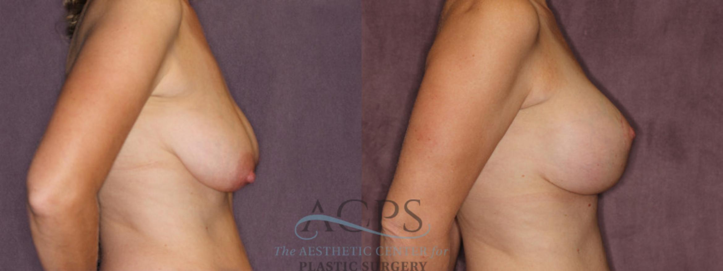 Before & After Breast Augmentation and Lift Case 1036 Side Right View: View in Houston, TX