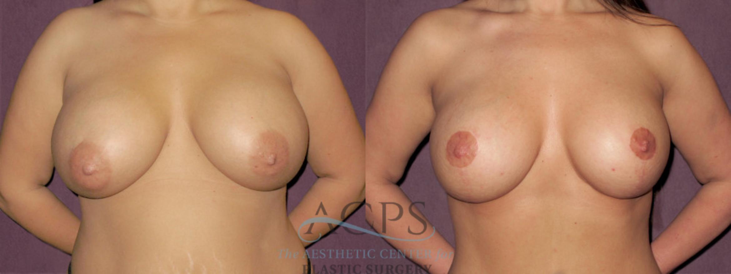 Before & After Breast Augmentation and Lift Case 1037 Front View: View in Houston, TX