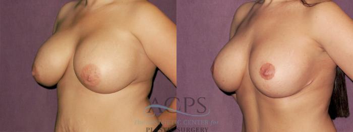 Before & After Breast Augmentation and Lift Case 1037 Oblique Left View: View in Houston, TX