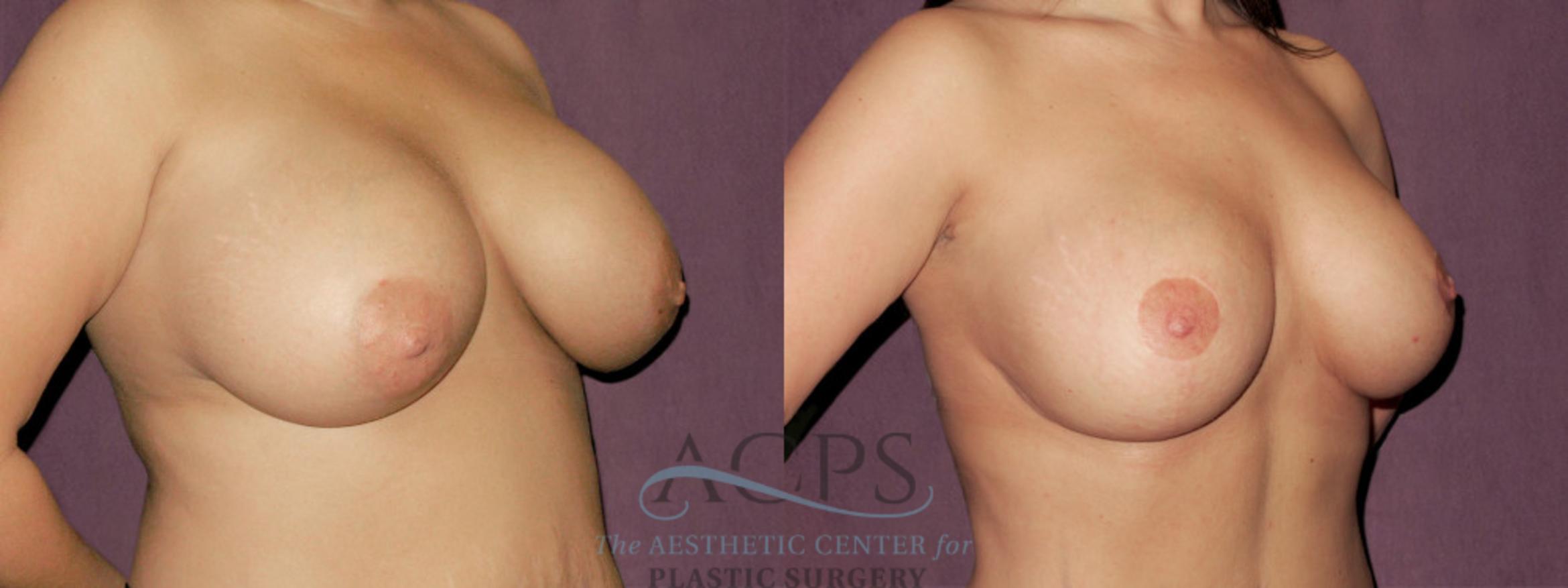Before & After Breast Augmentation and Lift Case 1037 Oblique Right View: View in Houston, TX