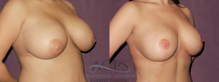 Before & After Breast Augmentation and Lift Case 1037 Oblique Right View: View in Houston, TX