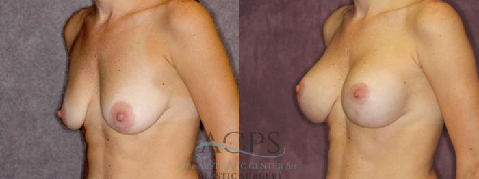 Before & After Breast Augmentation and Lift Case 1040 Oblique Left View: View in Houston, TX