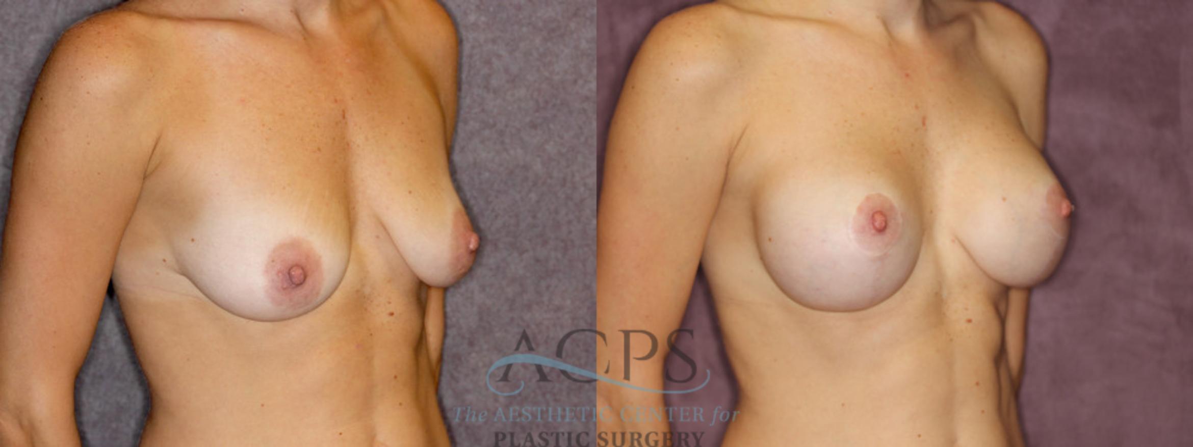 Before & After Breast Augmentation and Lift Case 1040 Oblique Right View: View in Houston, TX