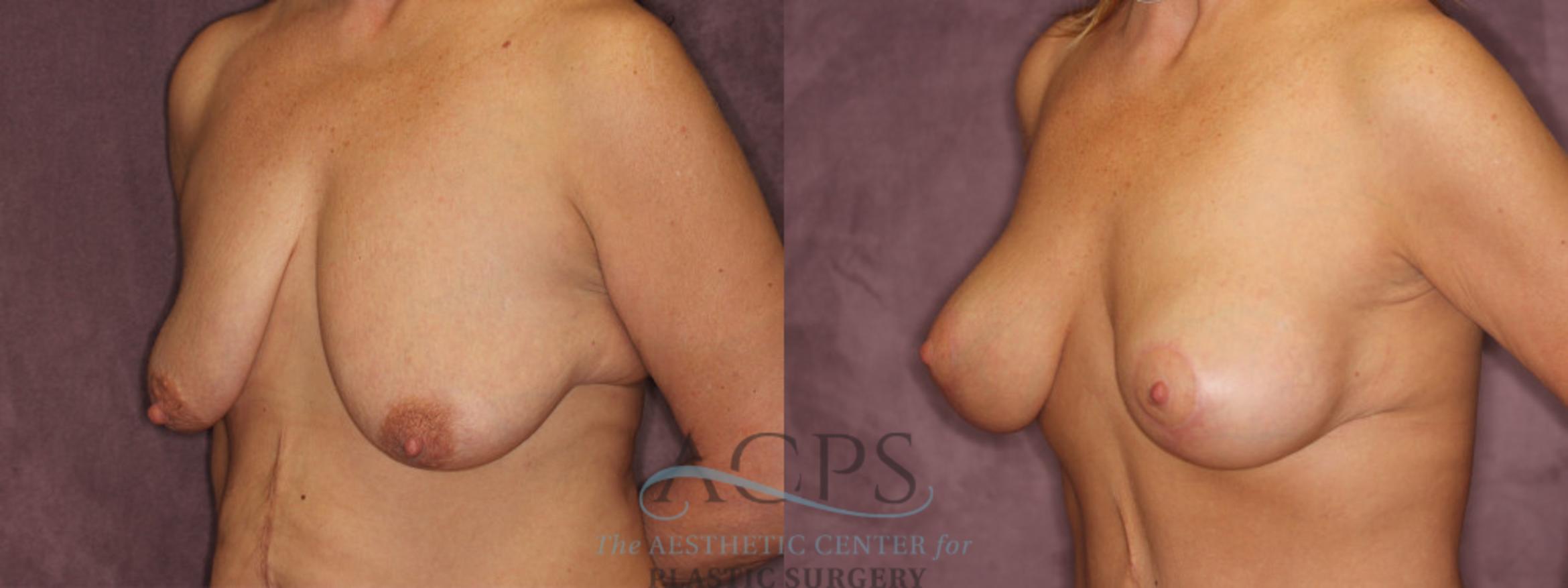 Before & After Breast Augmentation and Lift Case 1041 Oblique Left View: View in Houston, TX