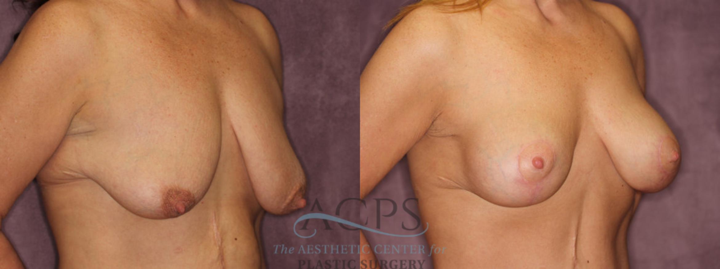 Before & After Breast Augmentation and Lift Case 1041 Oblique Right View: View in Houston, TX