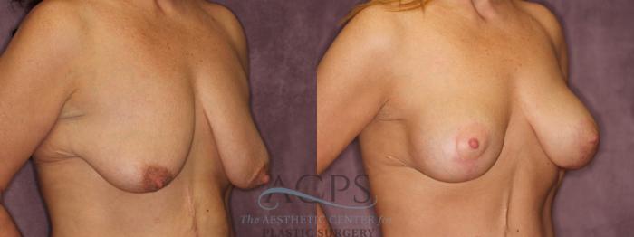 Before & After Breast Augmentation and Lift Case 1041 Oblique Right View: View in Houston, TX