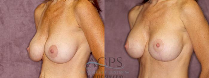 Before & After Breast Augmentation and Lift Case 1042 Oblique Left View: View in Houston, TX
