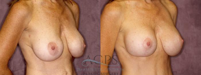 Before & After Breast Augmentation and Lift Case 1042 Oblique Right View: View in Houston, TX