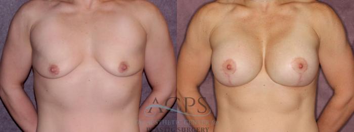 Before & After Breast Augmentation and Lift Case 1043 Front View: View in Houston, TX