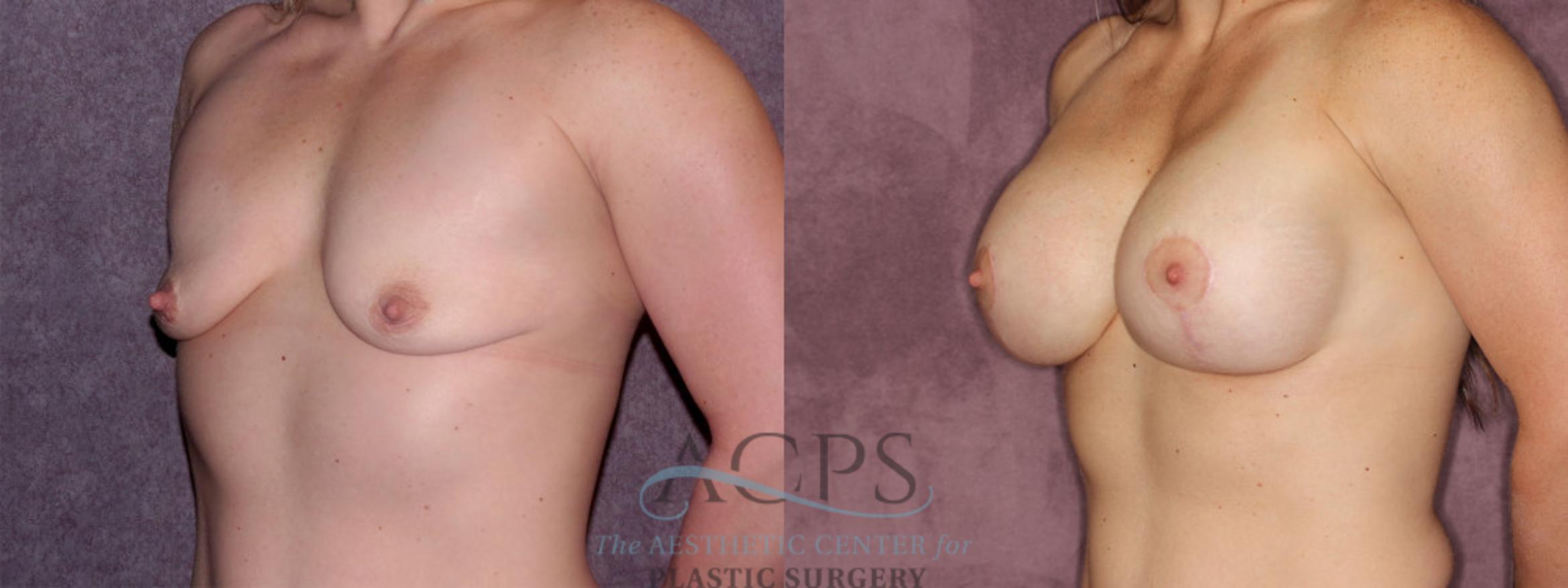 Before & After Breast Augmentation and Lift Case 1043 Oblique Left View: View in Houston, TX
