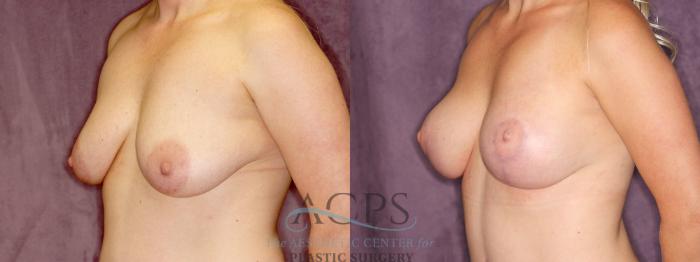Before & After Breast Augmentation and Lift Case 1044 Oblique Left View: View in Houston, TX