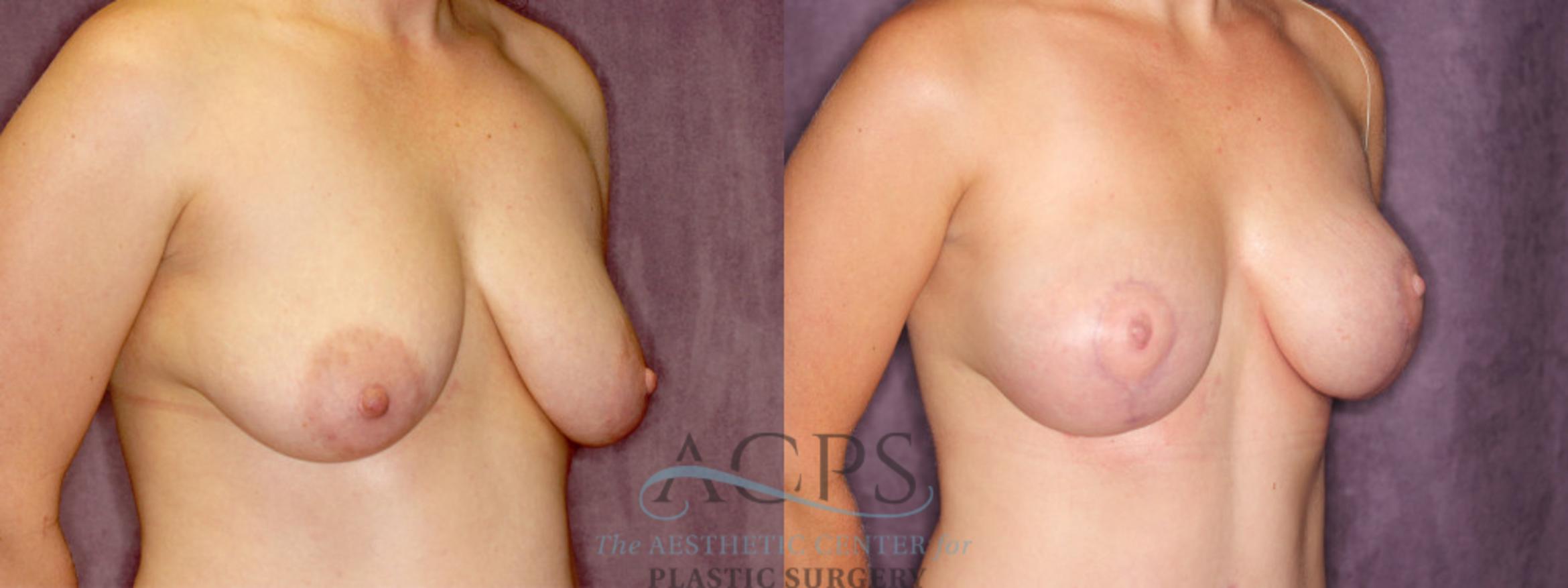 Before & After Breast Augmentation and Lift Case 1044 Oblique Right View: View in Houston, TX